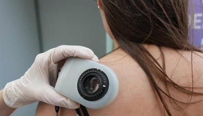 Na pregledu kože 181 građanin