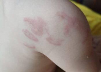 MAJKA IZ SARAJEVA TVRDI “Dijete nam se iz vrtića vratilo s 14 ugriza, obukli su joj majicu preko haljinice…”