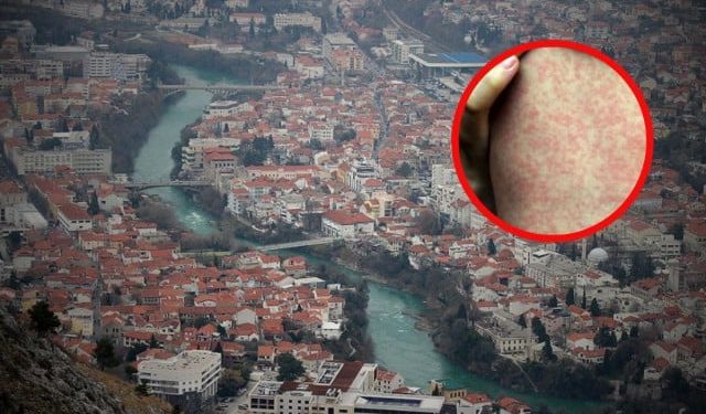 EPIDEMIJA OSPICA STIGLA U MOSTAR Iz Doma zdravlja otkrili zdravstveno stanje zaražene djece