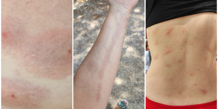 NAPAST NA MURTERU Jesu li slovenske turiste zaista izgrizle pješčane mušice i kako se zaštititi? | NACIONAL.HR