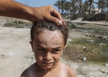 U Gazi se pojavio prvi slučaj dječje paralize u 25 godina uzrokovan kolapsom insfrastrukture