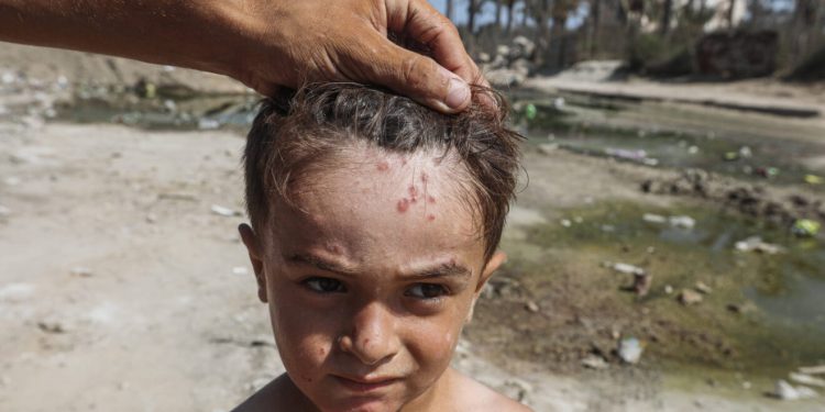 U Gazi se pojavio prvi slučaj dječje paralize u 25 godina uzrokovan kolapsom insfrastrukture