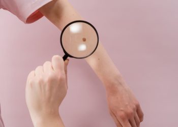 Bakar organizira preventivne preglede i edukacije o ranom otkrivanju melanoma