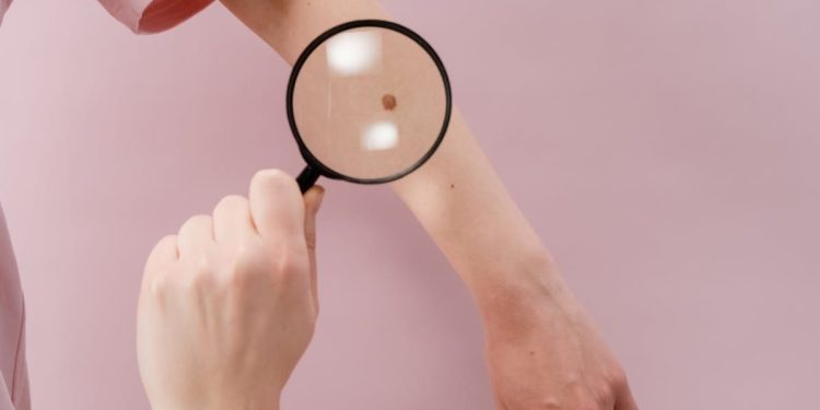 Bakar organizira preventivne preglede i edukacije o ranom otkrivanju melanoma