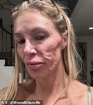 Brandi Glanville kaže da liječnici sumnjaju da je njezino stanje lica uzrokovano parazitom koji ¿skače¿ po njezinom licu; viđen u prosincu 2024