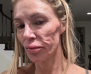 Brandi Glanville otkriva liječničku teoriju šoka o STVARNOM razlogu zašto je njezino lice sada neprepoznatljivo