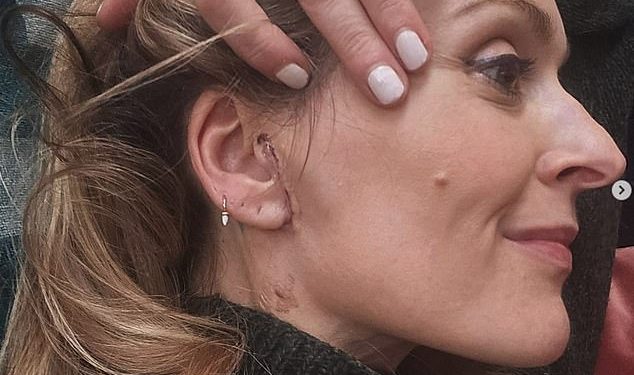 Fearne Cotton dijeli novosti o zdravstvenom stanju nakon operacije uklanjanja dvaju tumora – nakon šokantnog rastanka od supruga Jesseja Wooda