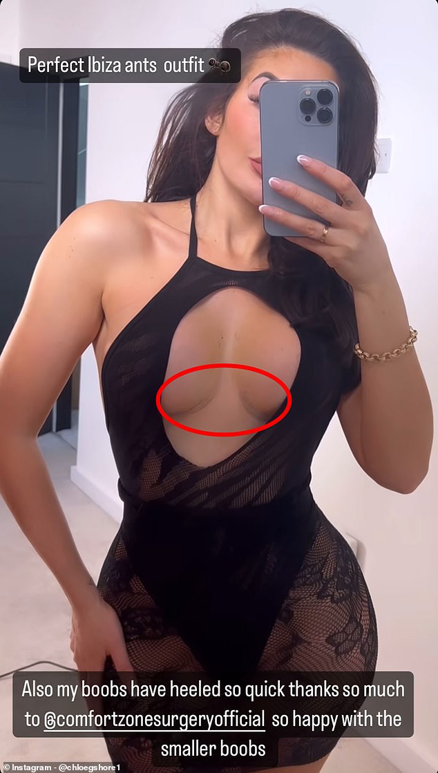 Reality zvijezda ponosno je pokazala svoje ožiljke od korekcije grudi na Instagramu u odvažnoj haljini s izrezom nakon što je odletjela u Tursku na uklanjanje implantata