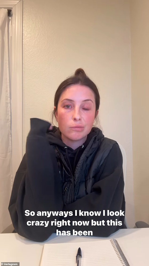 Influencer, 34, otkrio je u dugotrajnom Instagram videu da je lijeva strana njezina lica ostala uglavnom nepokretna zbog relativno uobičajenog neurološkog poremećaja