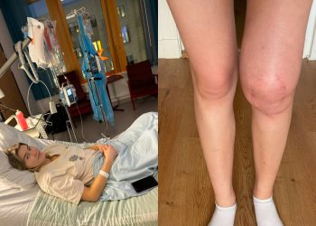 Student kojeg su liječnici otpustili zbog bolnog koljena kasnije je otkriveno da ima rijedak rak kostiju