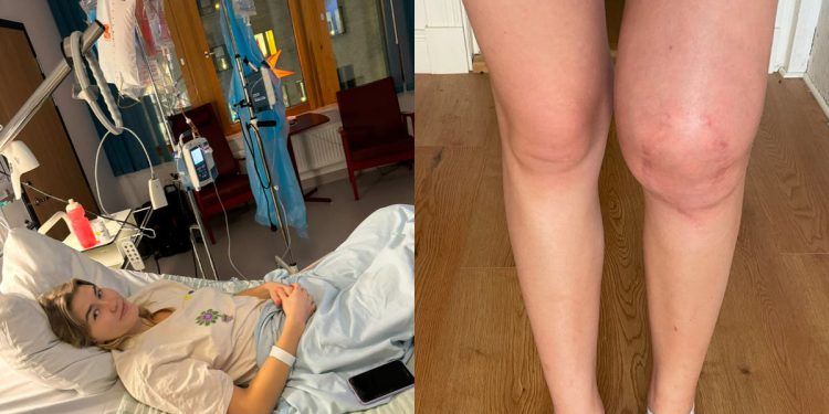 Student kojeg su liječnici otpustili zbog bolnog koljena kasnije je otkriveno da ima rijedak rak kostiju