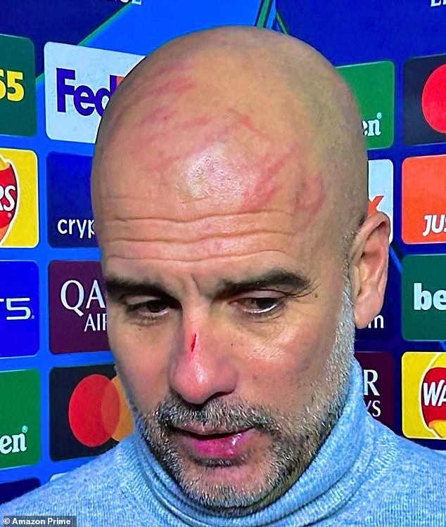 Guardiola je imao rez na nosu i ogrebotine po glavi nakon što je City ranije ove sezone bacio vodstvo od 3-0 protiv Feyenoorda