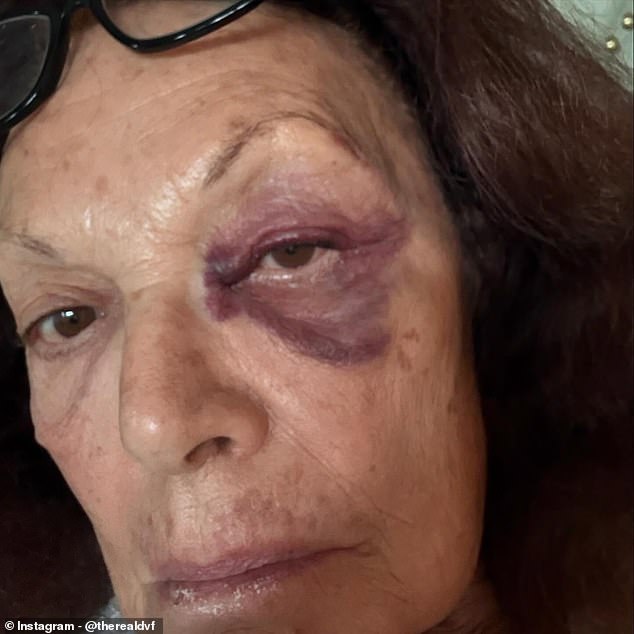 Izvor je rekao Page Six da je Diane ozlijeđena izvan kuće svoje kćeri. 