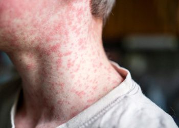 Deseci ljudi koji su sada bolesni u izbijanju ospica u Teksasu – uključujući i neke koji su cijepljeni