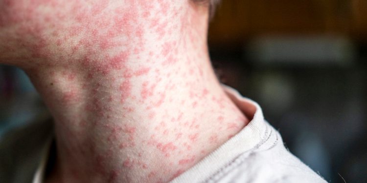Deseci ljudi koji su sada bolesni u izbijanju ospica u Teksasu – uključujući i neke koji su cijepljeni