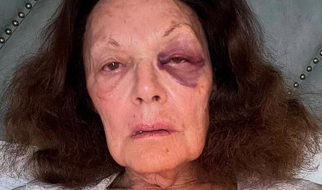 Diane von Furstenberg šokira obožavatelje nakon objave u vezi s fotografijom sebe kako ima crno oko