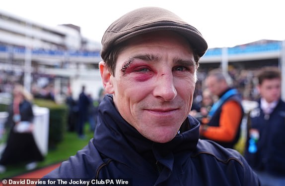 Jockey Harry Skelton s ozljedama lica nakon što ga je konj udario u nedjelju u prvom dan od 2025. Cheltenham festivala na trkalištu Cheltenham. Datum slike: utorak 11. ožujka 2025. PA Photo. Pogledajte PA Story Racing Cheltenham. Foto -kredit trebao bi pročitati: David Davies za Jockey Club/PA Wire.Resticions: Samo urednička upotreba, komercijalna upotreba podliježe prethodnom dopuštenju trkačkog staze Jockey Club/Cheltenham.