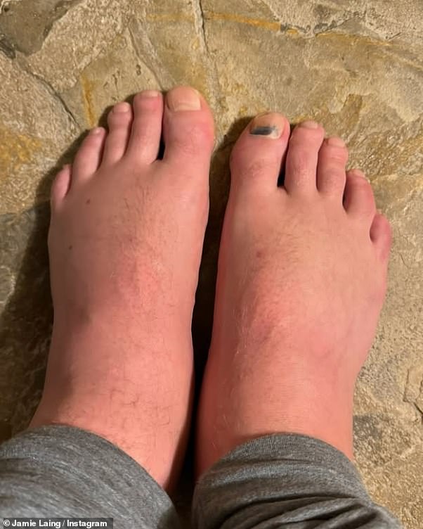 Danima ranije, Jamie je prišao na svoje Instagram priče s groznijim pucanjem svojih 'izmučenih' nogu koja su bila natečena, a jedan nokat s nožnim prstima gotovo padao