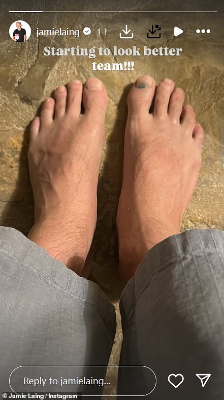 Sada je Jamie podijelio sa svojim sljedbenicima od 1,5 milijuna da mu oteklina stopala polako spušta dok je pucnula izbliza. Napisao je: 'Počinje izgledati bolje tim !!!'