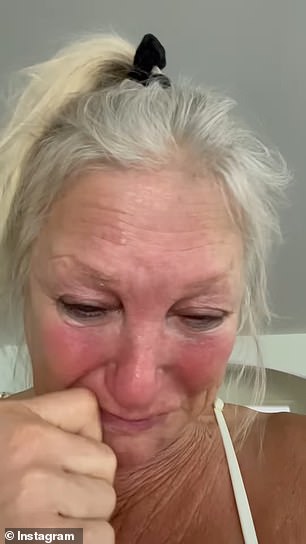 Što se tiče modrica na bradi, Linda je rekla da su rezultat nedavnog liječenja Botoxom