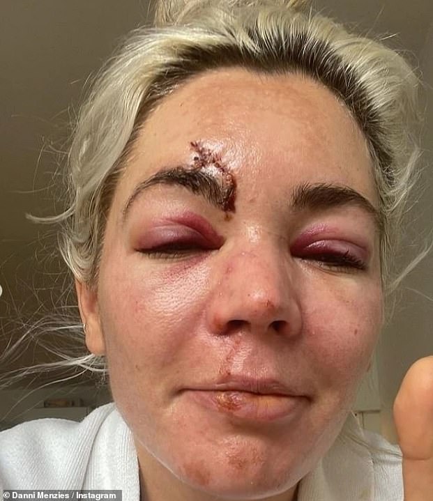 Bivši domaćin mjesta na suncu priznao je da ju je bivša napustila kad je 'izgledala poput Shreka' nakon stravične nesreće, zbog čega joj je potrebno 25 uboda (na slici listopada 2022.)