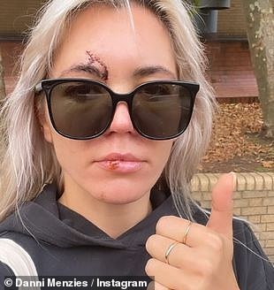 Danni je otkrio da je incident bio toliko ozbiljan da ju je ostavio u 'višemjesečnom potresu mozga'. Moped ju je pogodio u listopadu 2022. godine i podvrgnuo se mjesecima terapije (na slici 2022.)