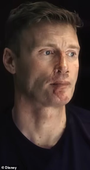 Flintoff je imao i tvrdog i mekog oštećenja tkiva