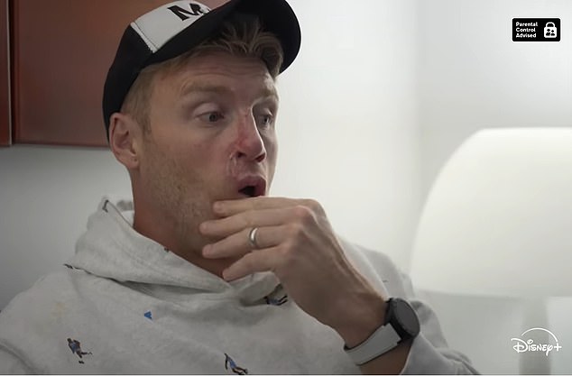 Flintoff je morao proći opsežne operacije na zubima i licem od nesreće