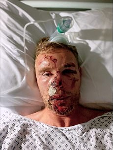 Flintoff je ostao s teškim ozljedama lica i nekoliko slomljenih rebara nakon skoro kosa u automobilskoj nesreći kada je u prosincu 2022. snimao Top Gear zajedno s McGuinnessom