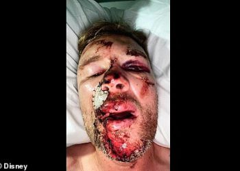 Andrew Flintoff’s gruesome injuries from near-fatal Top Gear crash where he ‘thought my face had come off’ shown in grisly new photos from his Disney documentary
