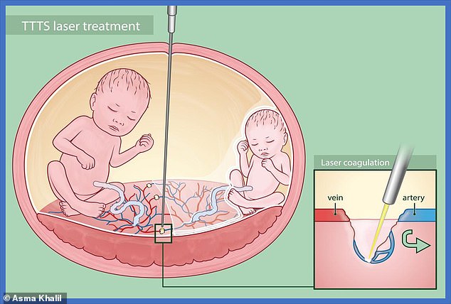 Asma Khalil, profesorica akušerstva i majčinske medicine fetusa u St. Georgeu, rekla je: 'Laserska operacija nije postupak bez rizika. Može pokrenuti rano rođenje ili pobačaj '