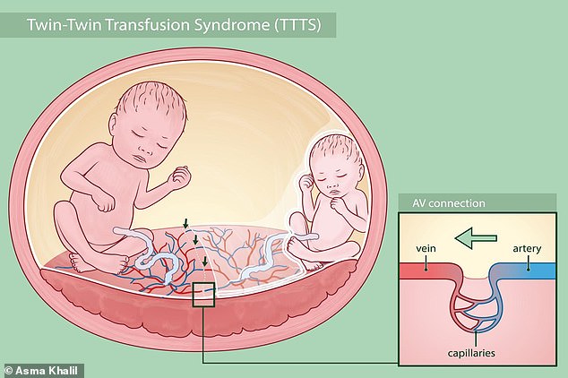 TTTS je rijetko, ali opasno po život koji pogađa 10 do 15% identičnih blizanaca koji dijele placentu (monohorionski blizanci)