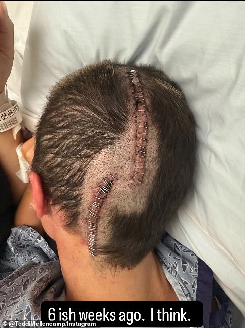 Također je podijelila jezivu sliku uboda na glavi nakon operacije mozga u veljači