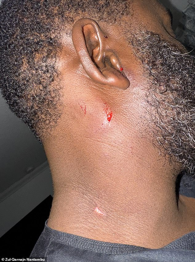 Zül-Qarna¿n Nantambu, koji na Instagramu ide '@FFF_ZULQARNAIN', podijelila je fotografije svojih ozljeda s Daily Mail-om. Nantambu kaže da mu je metak ispao vrat i slomio prst