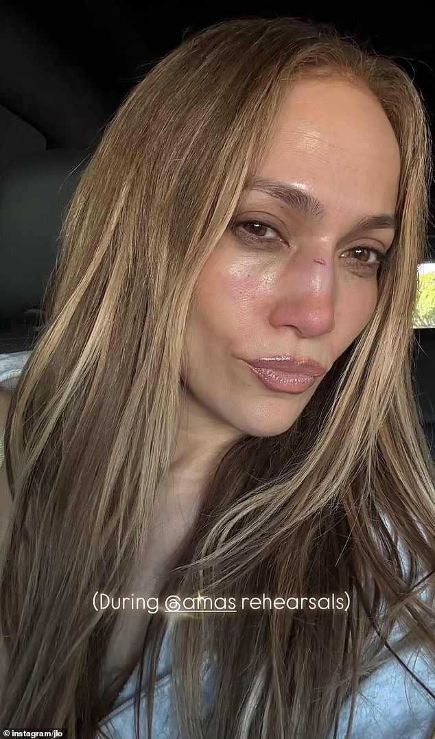 Pjevačica, 55, otkrila je sredinom svibnja da bi 'povrijedila' nos dok je vježbala 'vrlo visokoenergetski' plesni broj za godišnju ceremoniju