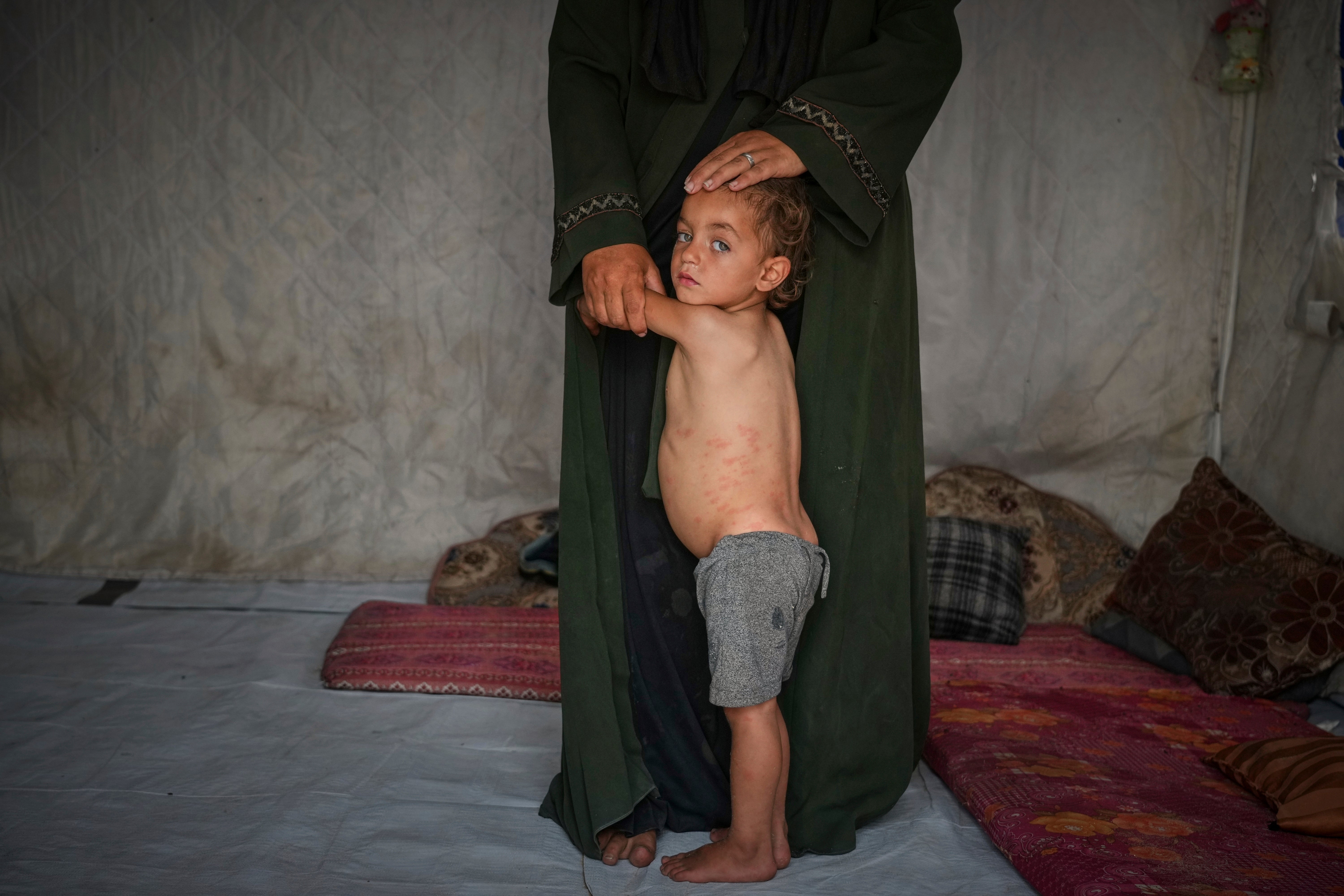 Mohammed Abu Hilal, 2, drži se majci Yasmine u njihovom šatoru u kampu Muwasi u Khanu Younisu, Southern Gazi Strip, nedjelja, 18. svibnja 2025.