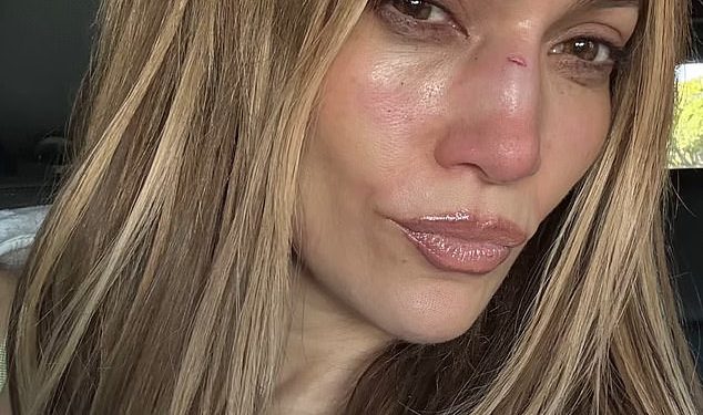 Jennifer Lopez trpi gadnu ozljedu lica nakon nesreće na pozornici