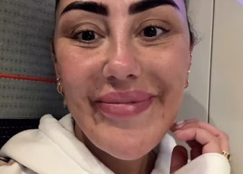 Sophie Kasaei pokazuje dramatične rezultate punila lica otopljenog na 30 milijuna funti Botox Clinic nakon što ju je alergijska reakcija ostavila s PTSP -om