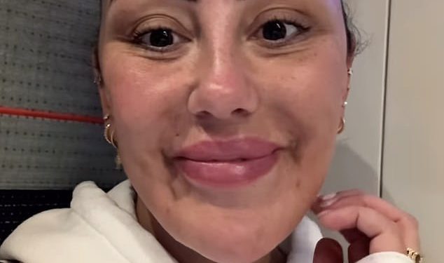 Sophie Kasaei pokazuje dramatične rezultate punila lica otopljenog na 30 milijuna funti Botox Clinic nakon što ju je alergijska reakcija ostavila s PTSP -om