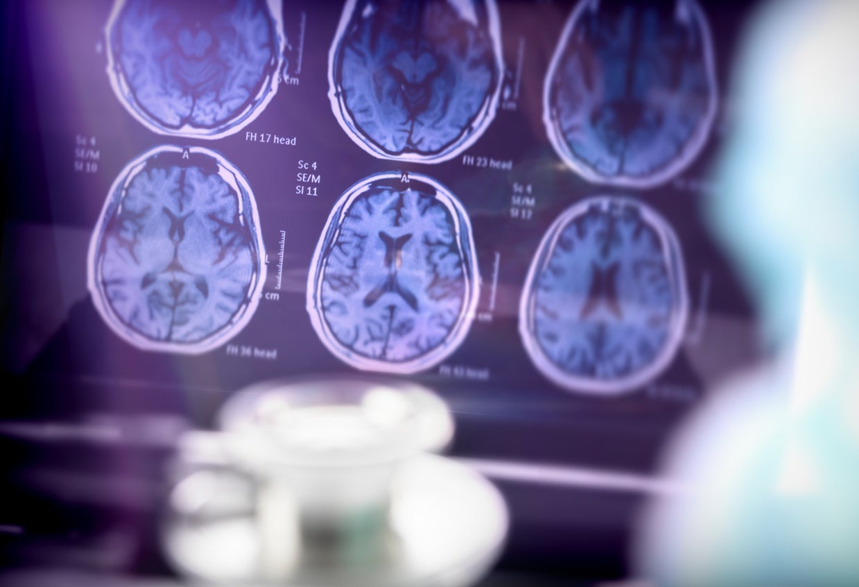 Prethodna istraživanja vezala su za sjedenje za demenciju. Nadalje, otkriveno je da stariji ljudi koji su sjedili više od 10 sati dnevno imaju veći rizik od razvoja Alzheimerove bolesti