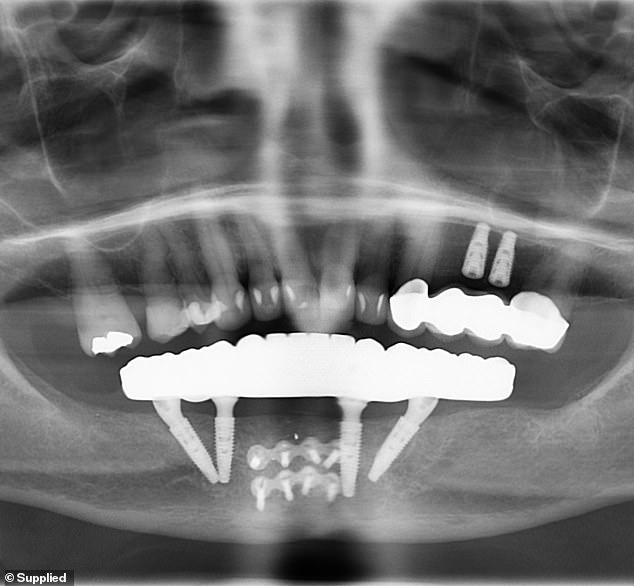 Druga stomatološka praksa potvrdila je da je Annetteino liječenje bilo pogrešno i da je dr. Hurst koristio niskokvalitetne materijale iz inozemstva. (Na slici: skeniranje njezinog zubnog rada)