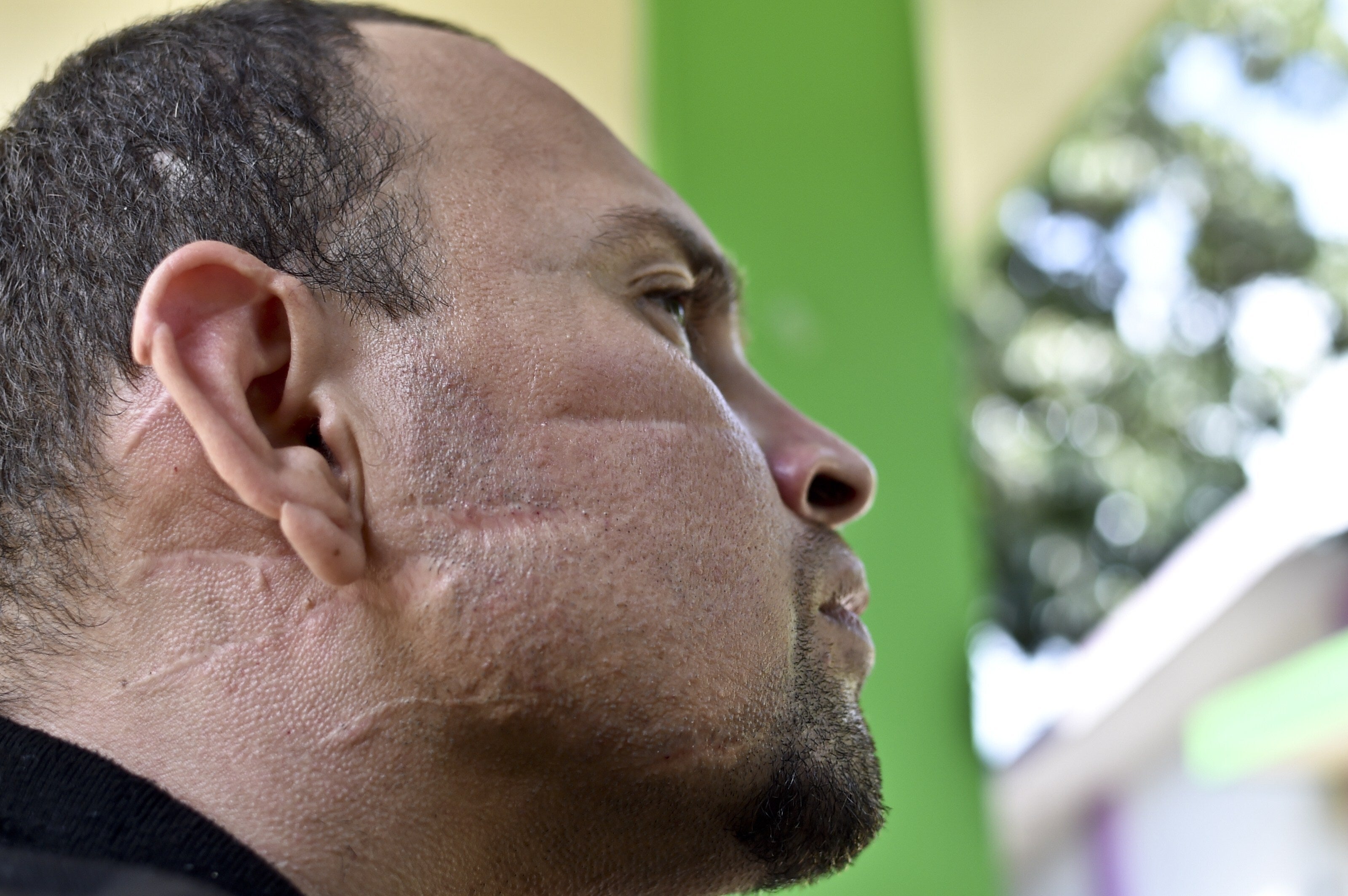 Central American migrant Jose Viera, who try to reach the border between Mexico and United States as he fleeing of the violence of his country, shows on September 2, 2014 in Tapachula, Chiapas state, Mexico, his face with some of about thirty-seven wounds made with a machete during an attack by gang members in El Salvador.