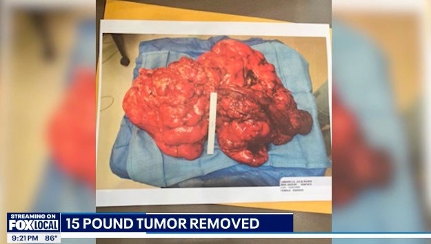 Veliki tumor uklonjen je s jasnim marginama tijekom svibnja u Chicagu