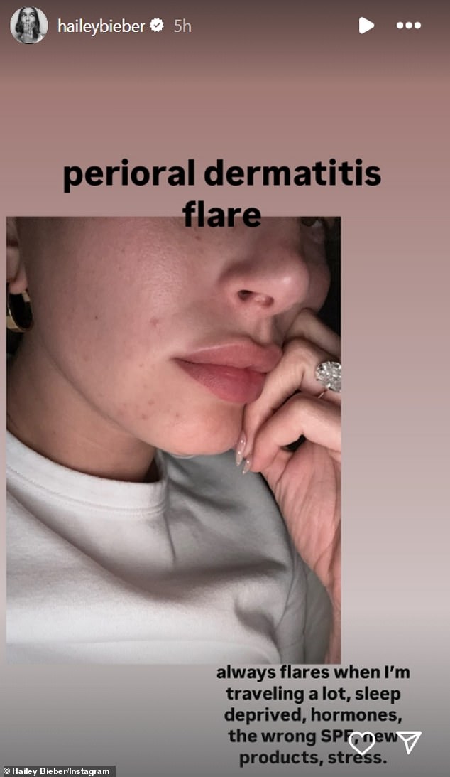 Mama od jedne otkrila je da je patila od 'perioralnog dermatitisa' i prenijela izbliza selfie kako bi pokazala crvenilo oko brade