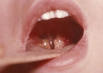 Liječnici alarmiraju: Širi se opasna bakterijska infekcija grla, povećan je rizik od zaraze! Ovo su glavni simptomi