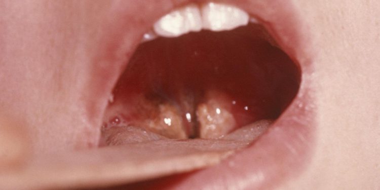 Liječnici alarmiraju: Širi se opasna bakterijska infekcija grla, povećan je rizik od zaraze! Ovo su glavni simptomi