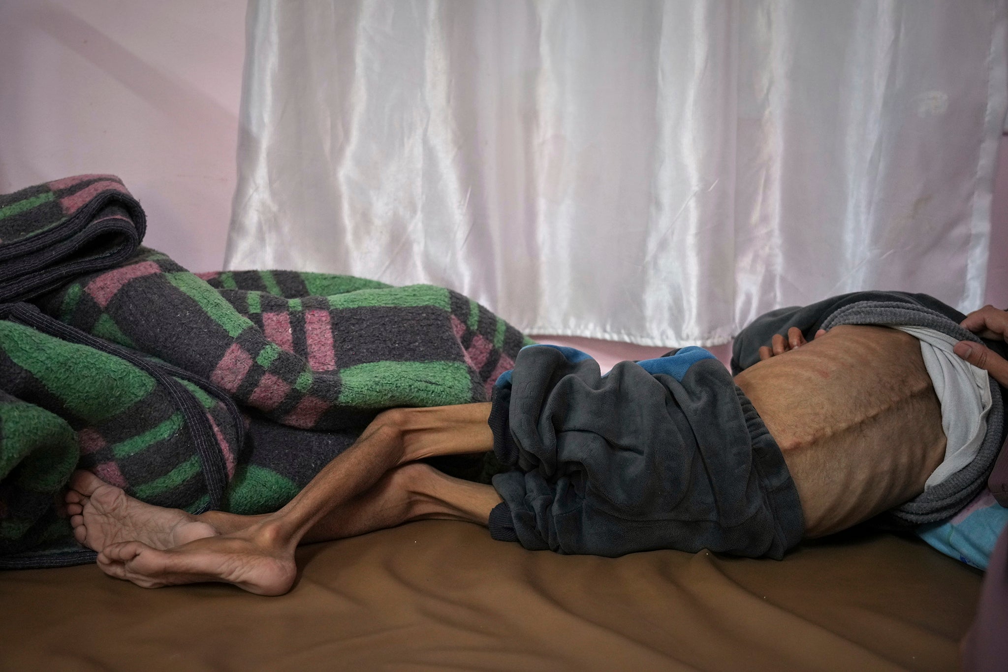 Mona al-Raqab podiže košulju svog petogodišnjeg sina Osame al-Rakaba, otkrivajući znakove pothranjenosti i pogoršanu cističnu fibrozu