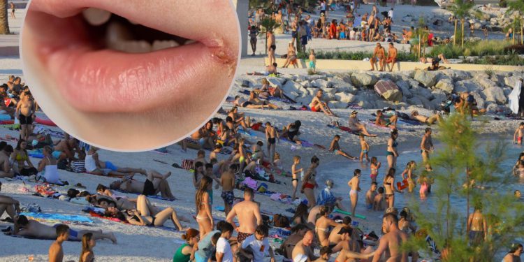Slobodna Dalmacija – Roditelji, pripazite ako vam dijete dođe s mora i ospe se, možda je u pitanju ova zarazna bolest: ‘Da, ima slučajeva…’