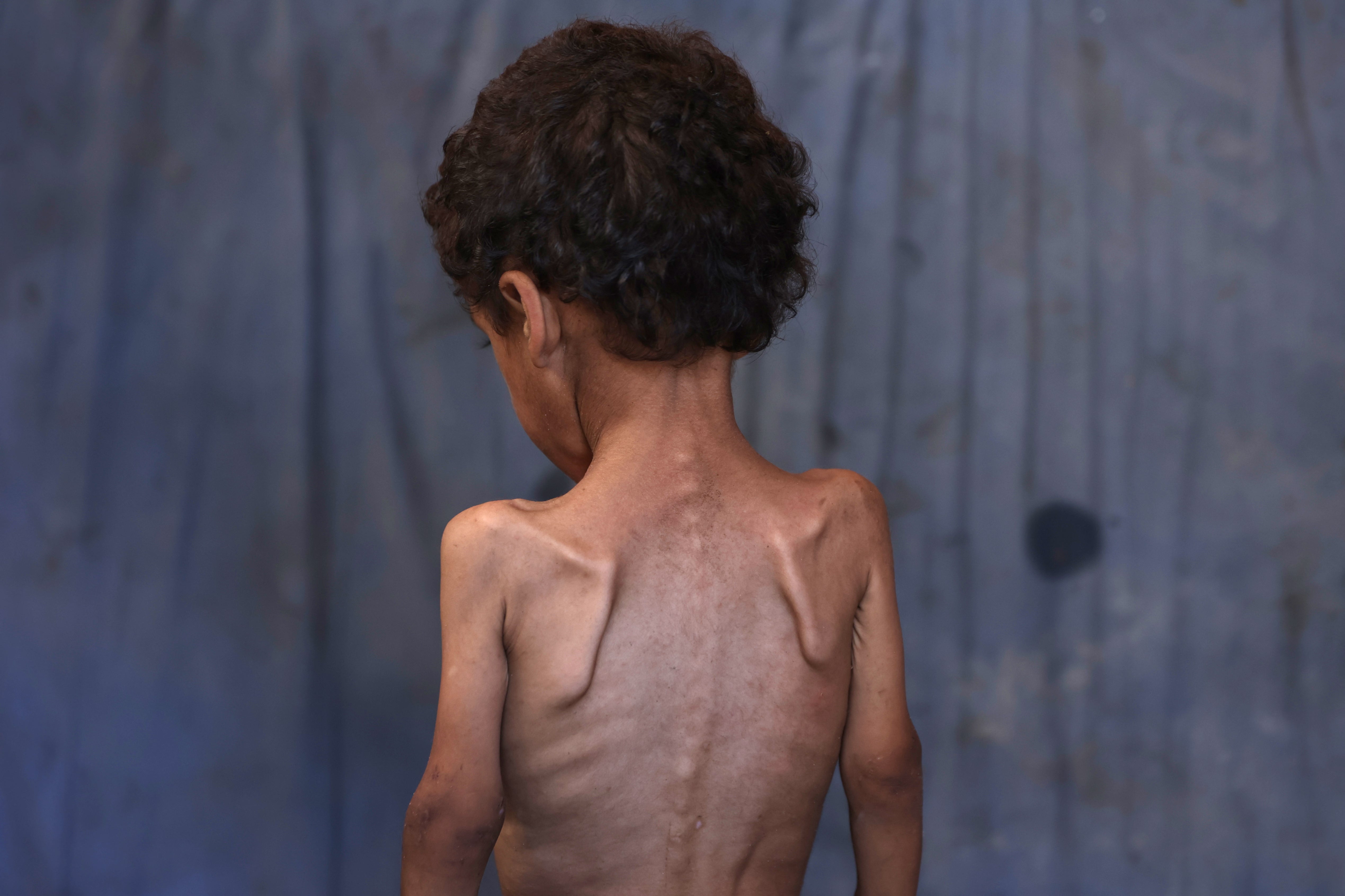Yazan, pothranjeni dvogodišnji palestinski dječak, u oštećenom domu njegove obitelji u izbjegličkom kampu Al-Shati, zapadno od grada Gaze