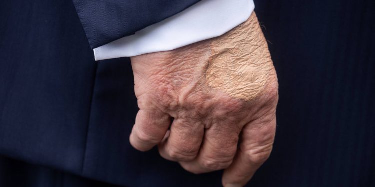 Trumpova neobična modrica odvija se ponovno pojavljivanje prije posjeta predsjedniku Pittsburghu